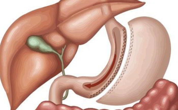 What is gastrectomy?