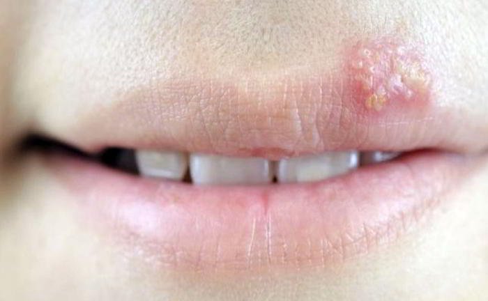 What is genital herpes