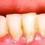 What is gingivitis?
