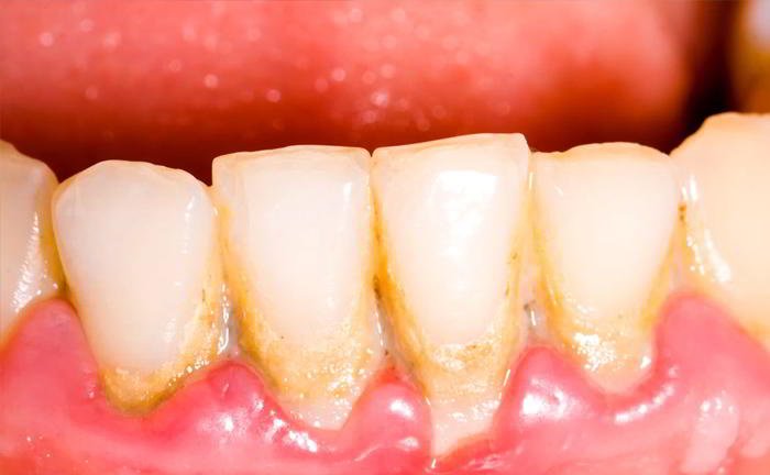 What is gingivitis?