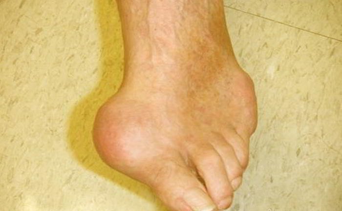 What is gout and is it hereditary?