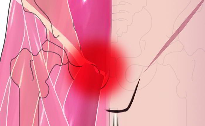 What is hernia?