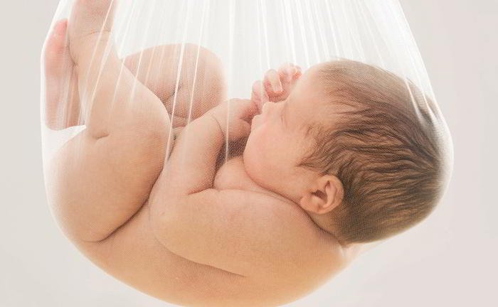 What is hydramnios?
