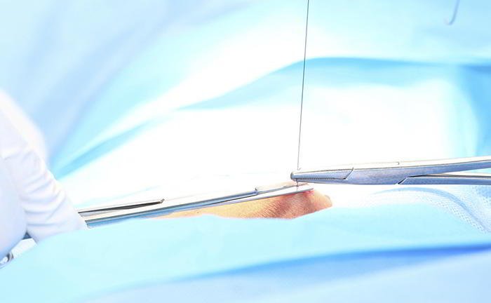 What is meant by episiotomy?