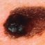 What is melanoma?