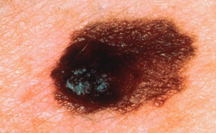 What is melanoma?