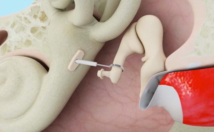 What is otosclerosis?