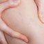 What is phlebitis and what is the treatment?