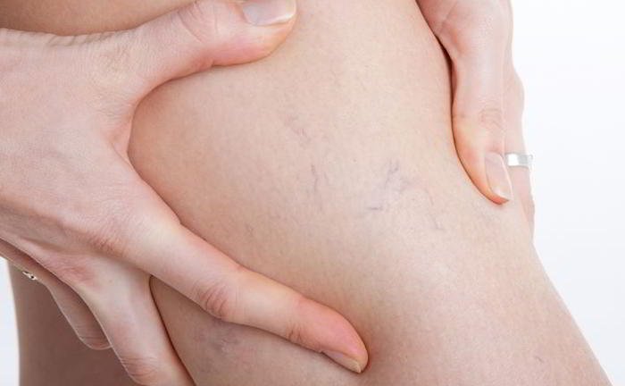 What is phlebitis and what is the treatment?