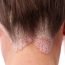 What is psoriasis?