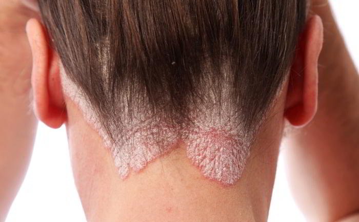 What is psoriasis?