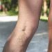What is the cause for varicose veins?