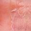 What is the difference between eczema and dermatitis?