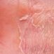 What is the difference between eczema and dermatitis?