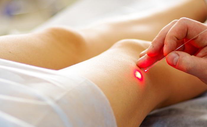 What is the treatment for varicose veins?