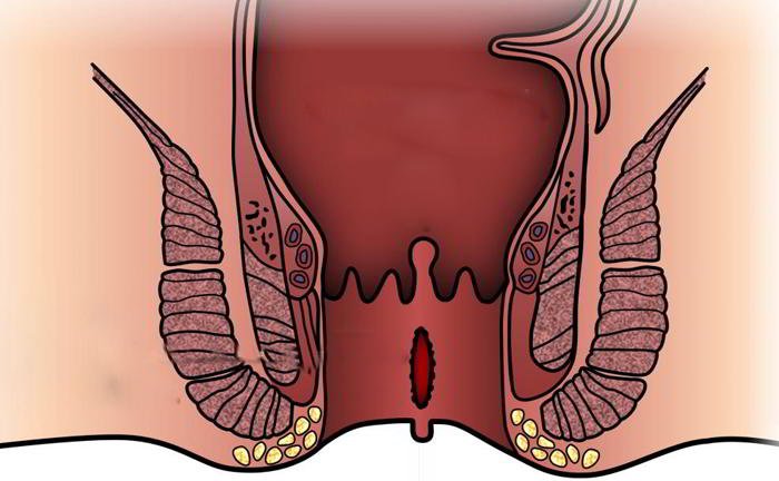 What is the treatment of anal fissure?