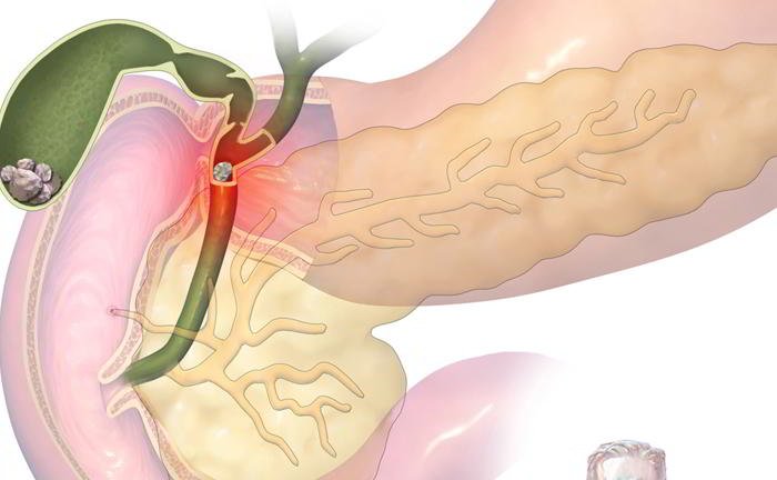 What is the treatment of gallstones?