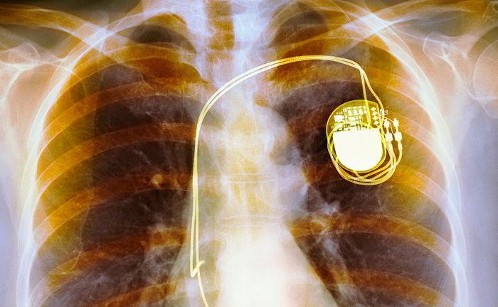 What is the use for pacemaker and hoe does it work?
