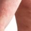 What should be done to get some relief from psoriasis?