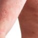 What should be done to get some relief from psoriasis?