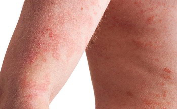 What should be done to get some relief from psoriasis?