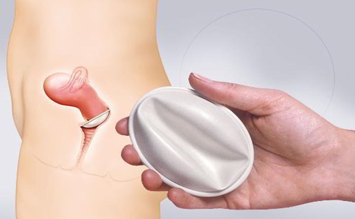 When should diaphragm be inserted?