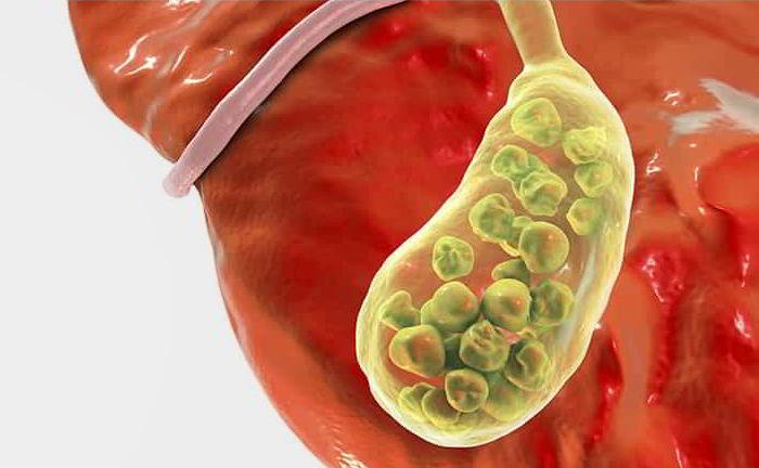 Who all may suffer from gallstones?