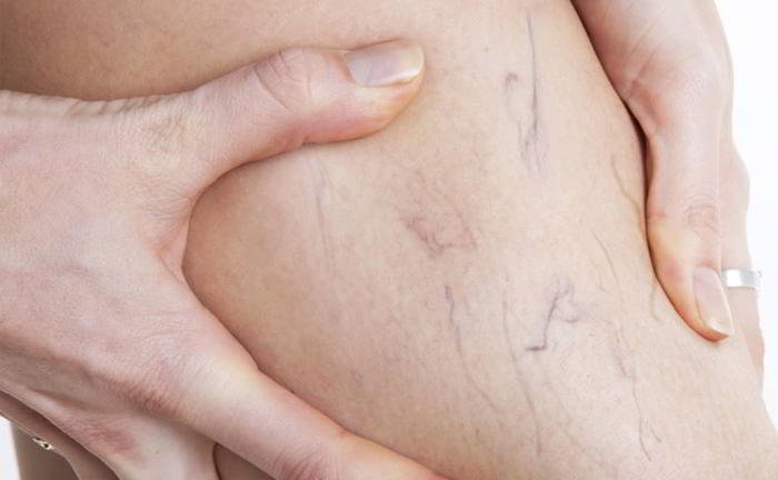 Why are pregnant women more prone to varicose veins?