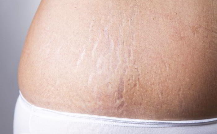 Why are there stretch marks on my stomach?