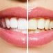Why do teeth become discoloured?