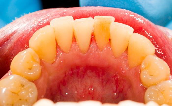 Why do we mean by plaque?