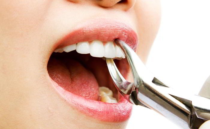 Why is it named 'wisdom teeth'?