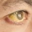 Why is it that people who suffer from jaundice turn yellow?