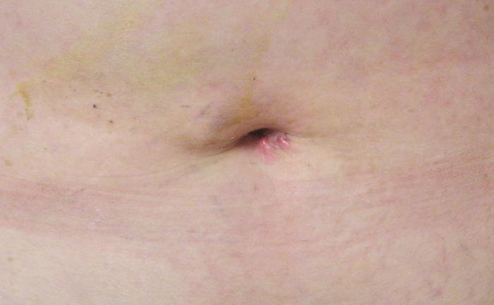 Will I be scarred after gall bladder operation?