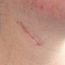 Will the scar around the throat fade after some time or not?