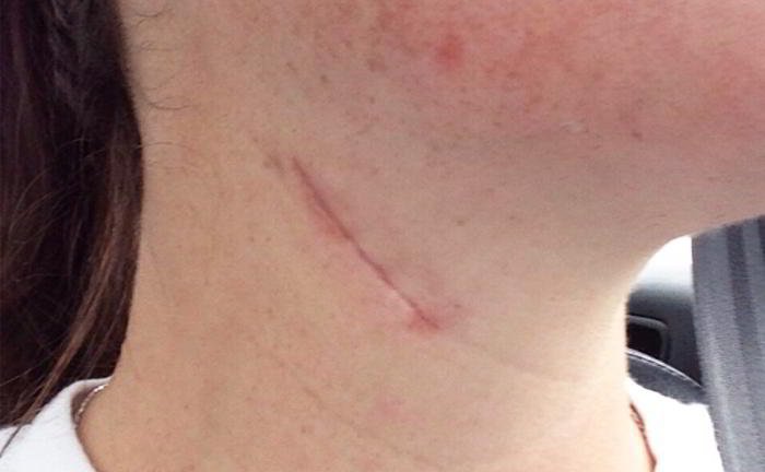 Will the scar around the throat fade after some time or not?